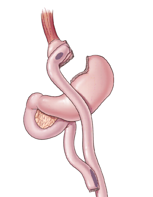 المرشحون لعملية شد الجسم بعد تحويل المسار