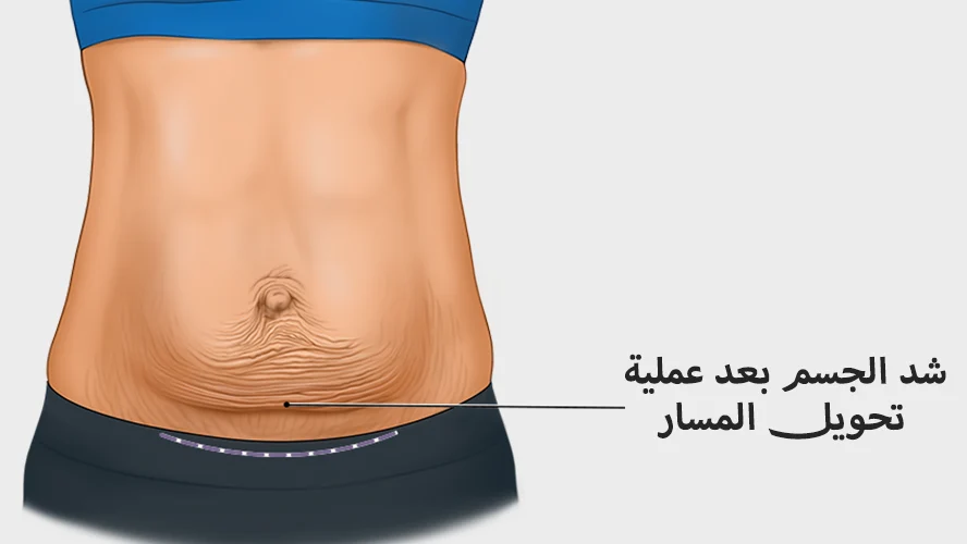 شد الجسم بعد عملية تحويل المسار نصائح لنتائج مثالية