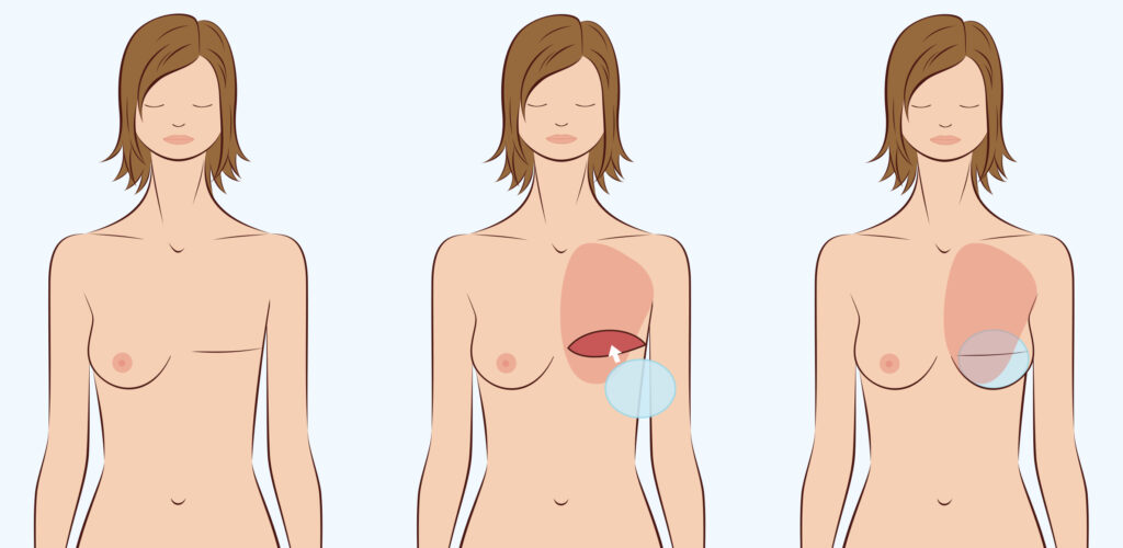 عملية ترميم الثدي بعد السرطان