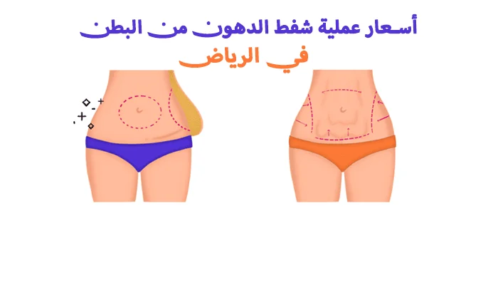 أسعار عملية شفط الدهون من البطن في الرياض