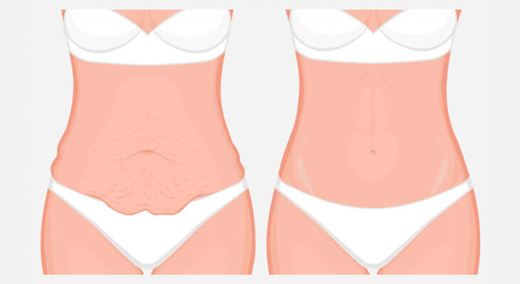 المخاطر المحتملة لعملية شد البطن