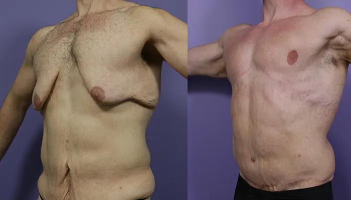 تكلفة عملية شد الجسم بعد التخسيس في 2025