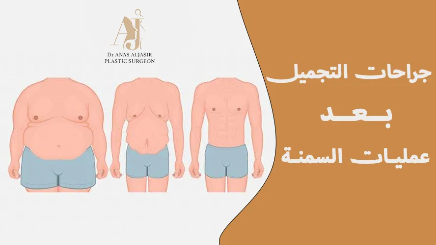 جراحات التجميل بعد عمليات السمنة: متى تعيد تشكيل جسمك؟