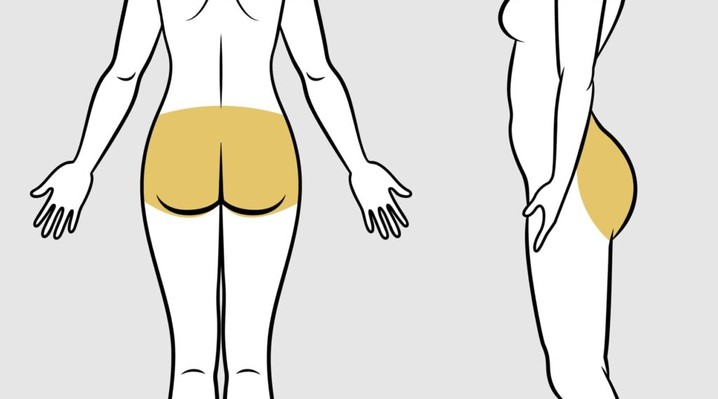 زراعة الدهون في الأرداف: التكلفة والمميزات والمخاطر