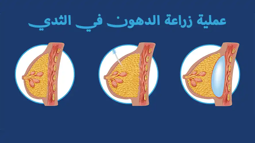 زراعة الدهون في الثدي: الإيجابيات والسلبيات