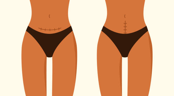 شد البطن بعد الولادة القيصرية: هل هو حل آمن؟