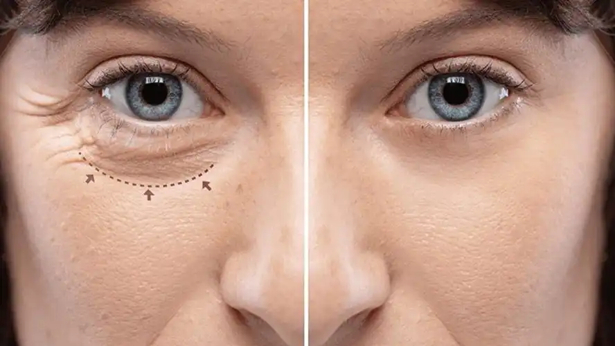 شد الجفون مع شد الوجه هل يمكن الجمع بينهما؟