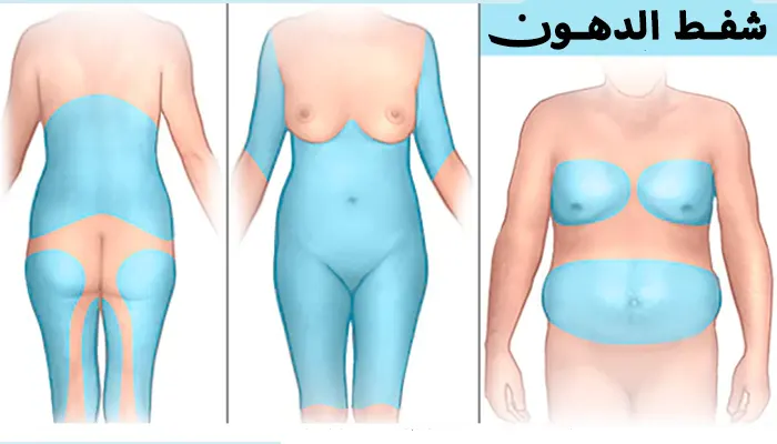 عمليات شفط الدهون في الرياض