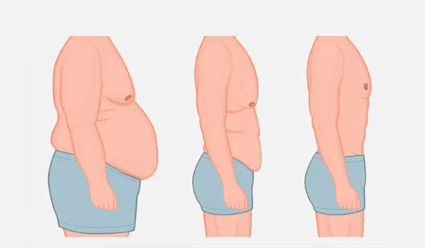 فوائد جراحات التجميل بعد عملية السمنة