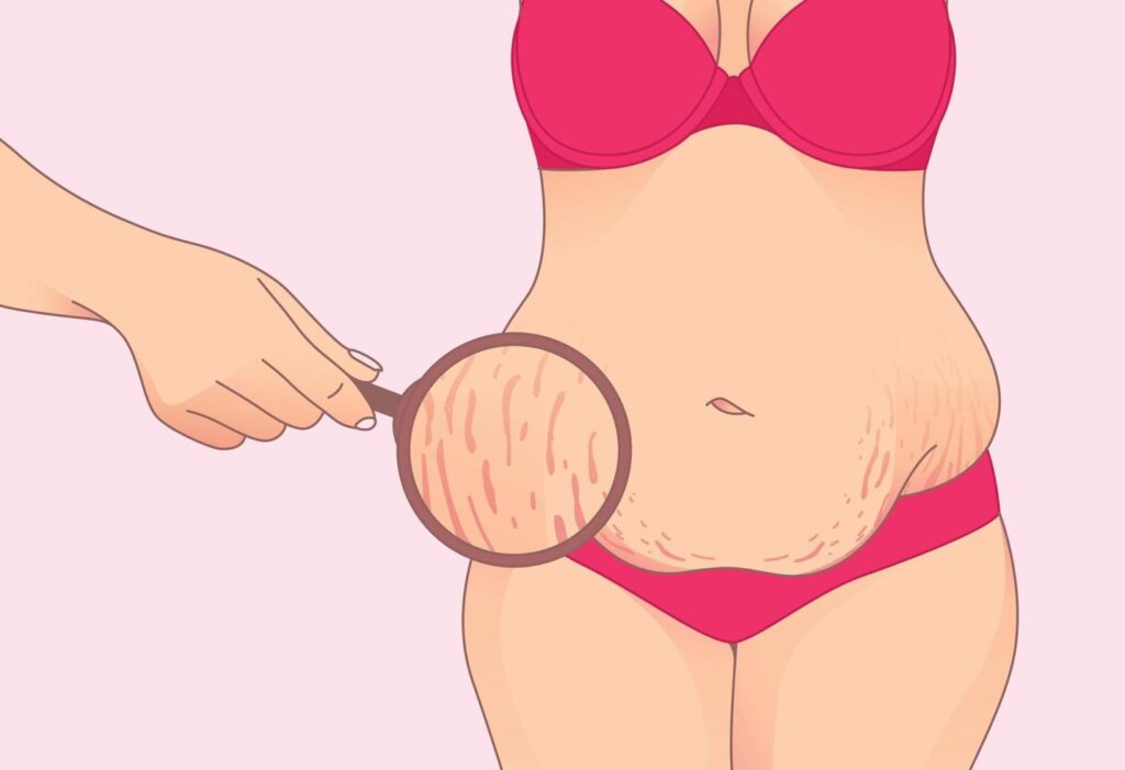 كيف تتم عملية شد البطن بعد الولادة؟