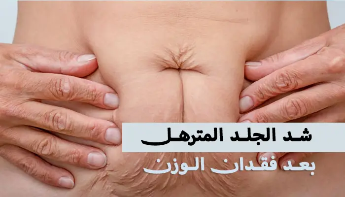 كيفية شد الجلد المترهل بعد فقدان الوزن؟