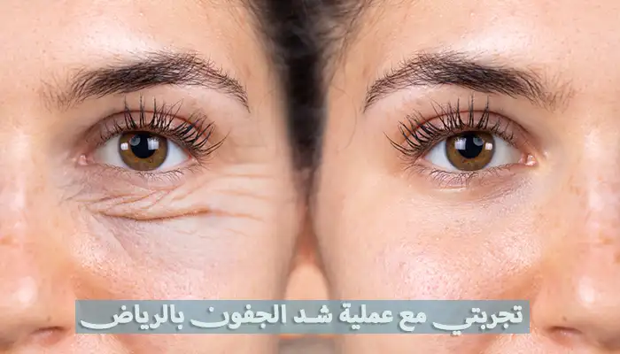 تجربتي مع عملية شد الجفون في الرياض