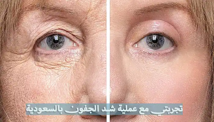 تجربتي مع عملية شد الجفون في السعودية