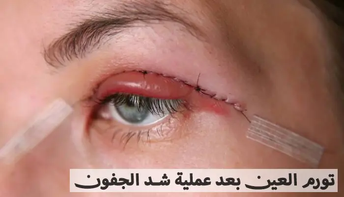 تورم العين بعد عملية شد الجفون - 6 نصائح وقائية