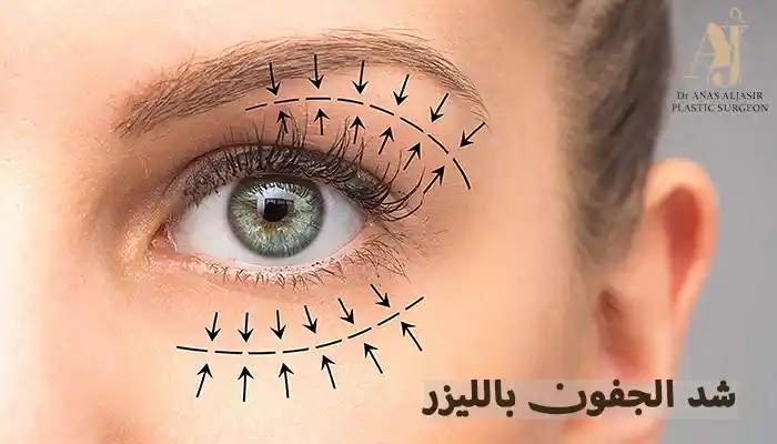 شد الجفون بالليزر: الحل المبتكر لاستعادة شباب العين