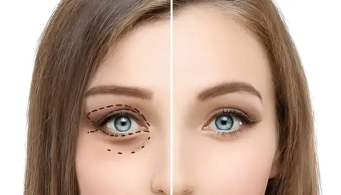 متى تظهر نتيجة عملية شد الجفون