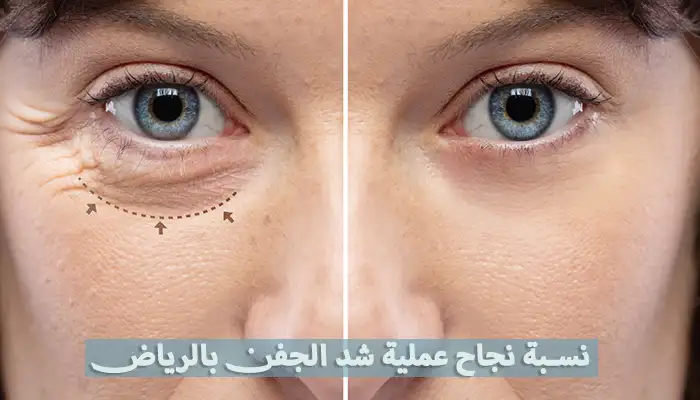 نسبة نجاح عملية شد الجفن بالرياض