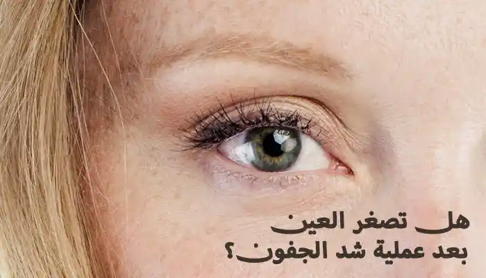هل تصغر العين بعد عملية شد الجفون؟
