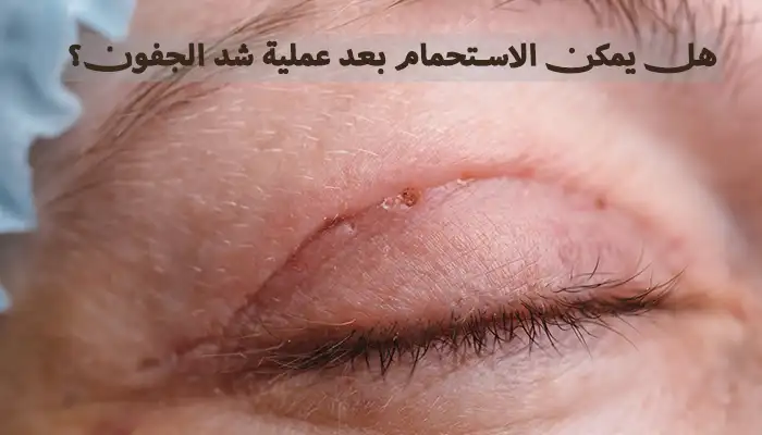 هل يمكن الاستحمام بعد عملية شد الجفون؟