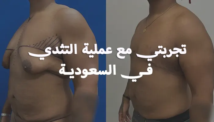 تجربتي مع عملية التثدي في السعودية