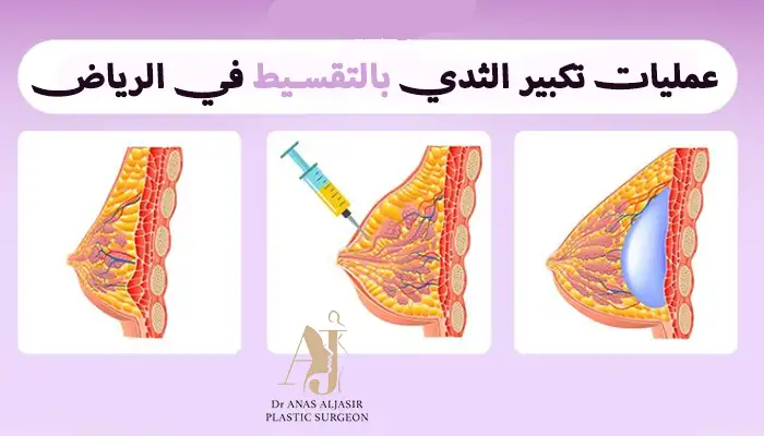 عمليات تكبير الثدي بالتقسيط في الرياض