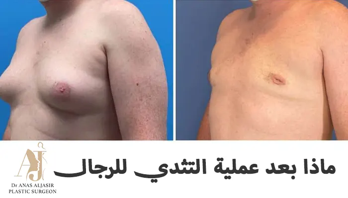 ماذا بعد عملية التثدي للرجال!