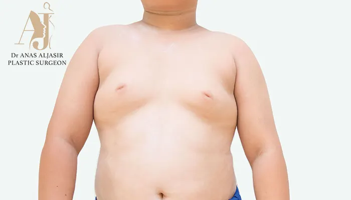 مشكلة التثدي عند الاولاد