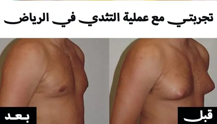 تجربتي مع عملية التثدي في الرياض