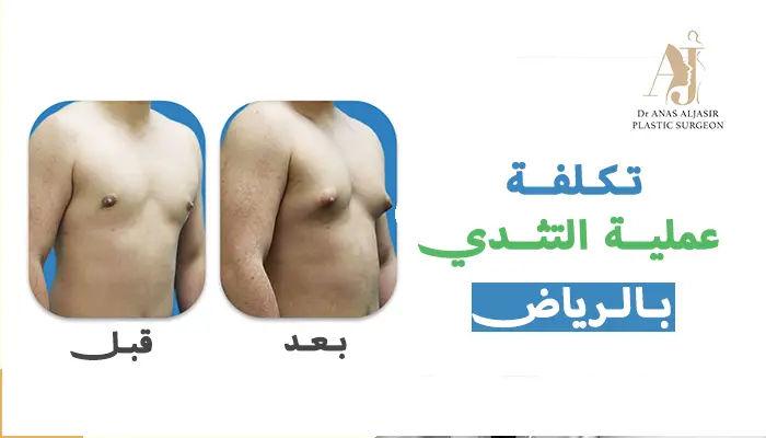 تكلفة عملية التثدي في الرياض