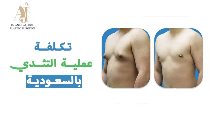 تكلفة عملية التثدي في السعودية
