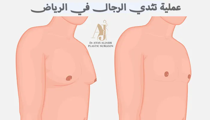 عملية تثدي الرجال في الرياض