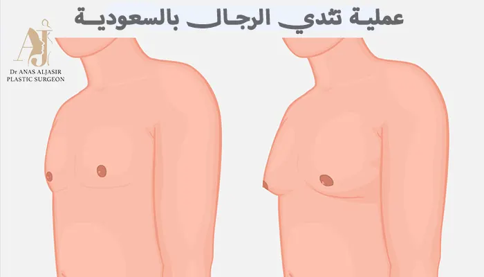 عملية تثدي الرجال في السعودية