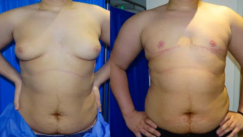 3. الدرجة الثالثة: تضخم واضح مع ترهل ملحوظ