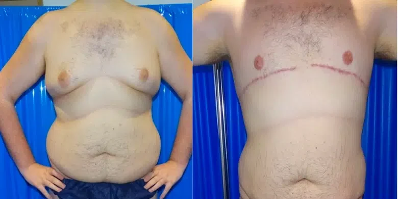 4. الدرجة الرابعة تضخم شديد مع ترهل واضح وكبير