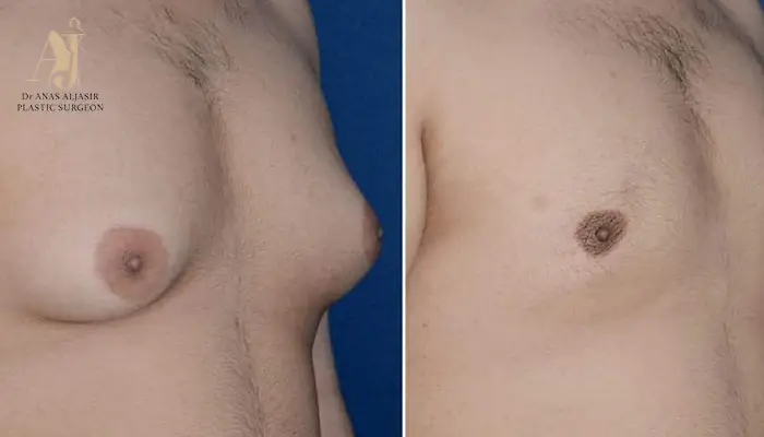 الفرق بين التثدي والدهون