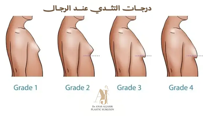 درجات التثدي عند الرجل
