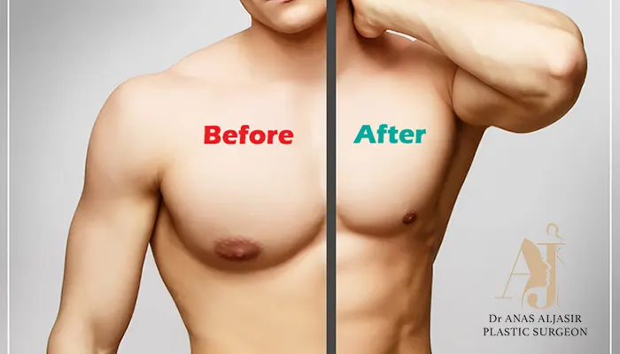 كيفية تجنب عملية التثدي الفاشلة