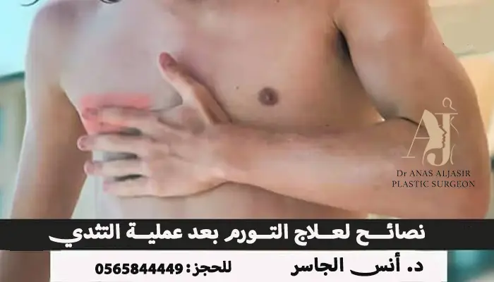 نصائح لعلاج التورم بعد عملية التثدي