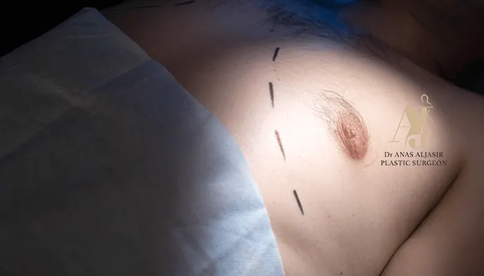 هل يترهل الجلد بعد عملية التثدي؟