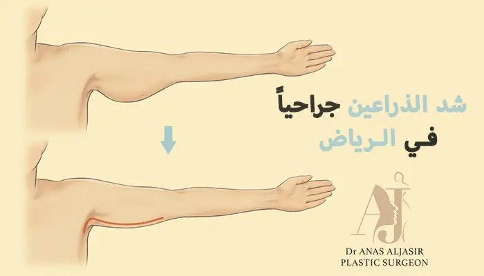 شد الذراعين جراحياً في الرياض