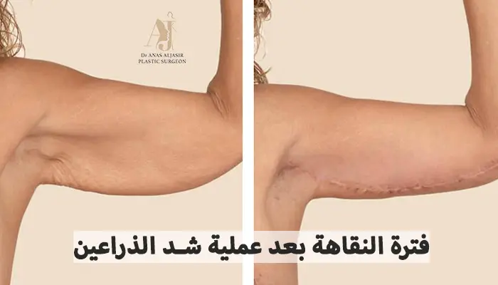 فترة النقاهة بعد عملية شد الذراعين