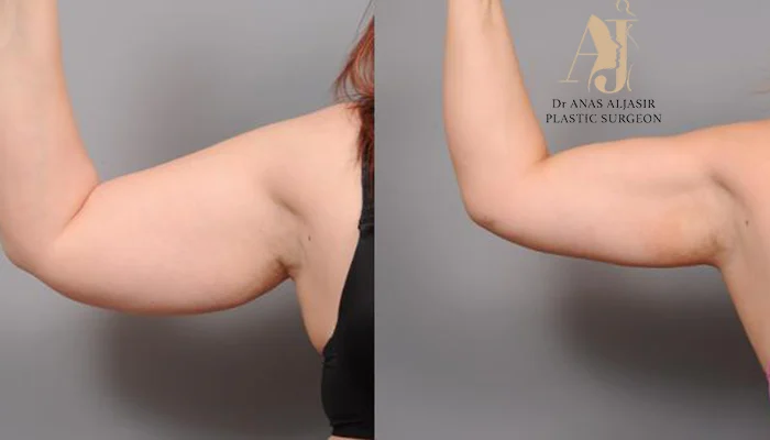 تجربتي مع شفط دهون الذراعين في الرياض