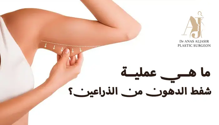 ما هي عملية شفط الدهون من الذراعين؟