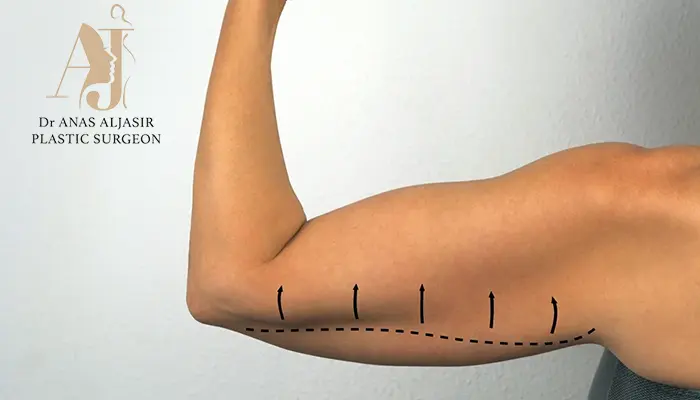 أفضل توقيت لعملية شد الذراعين: دليل اتخاذ القرار