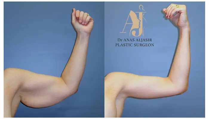 ما هي عملية شد جلد الذراعين؟