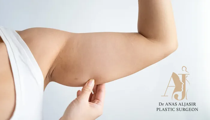 أنواع ترهل الذراع