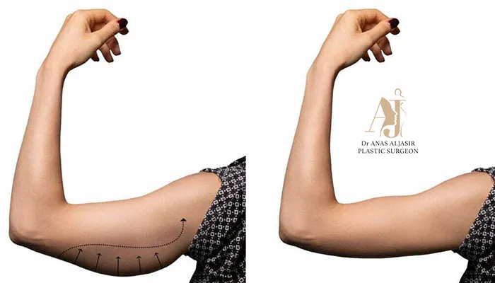 سعر عملية شد الزنود في السعودية