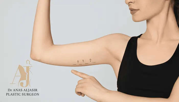 شد الذراعين أم شفط الدهون؟ أيهما الأنسب لك؟