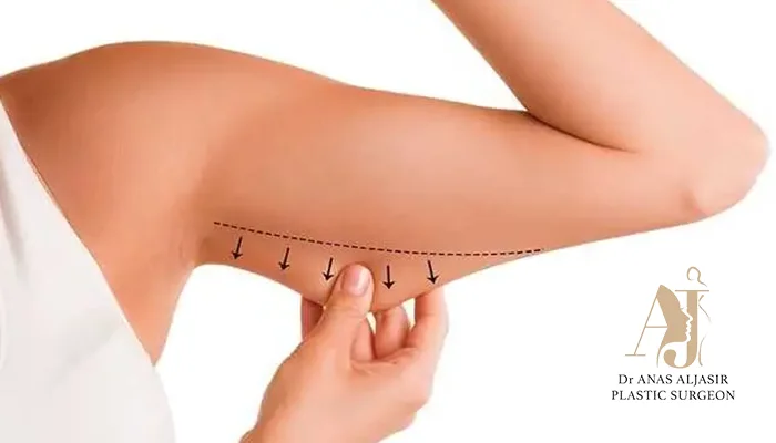 شد الذراعين بالخيوط التجميلية في الرياض