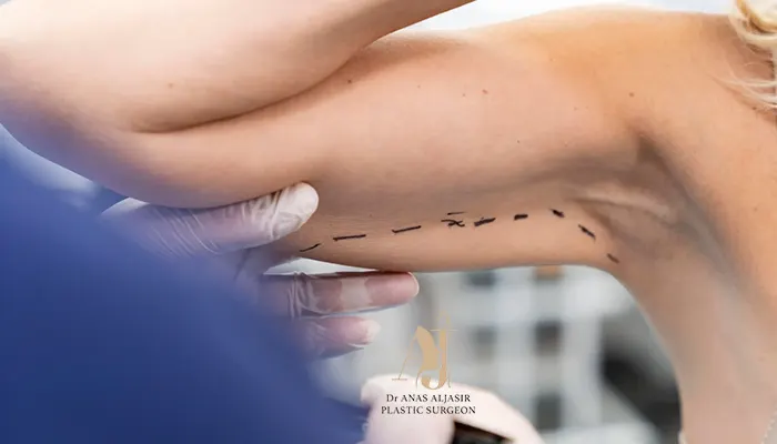 كيف تتم عملية شد الزنود بالليزر؟